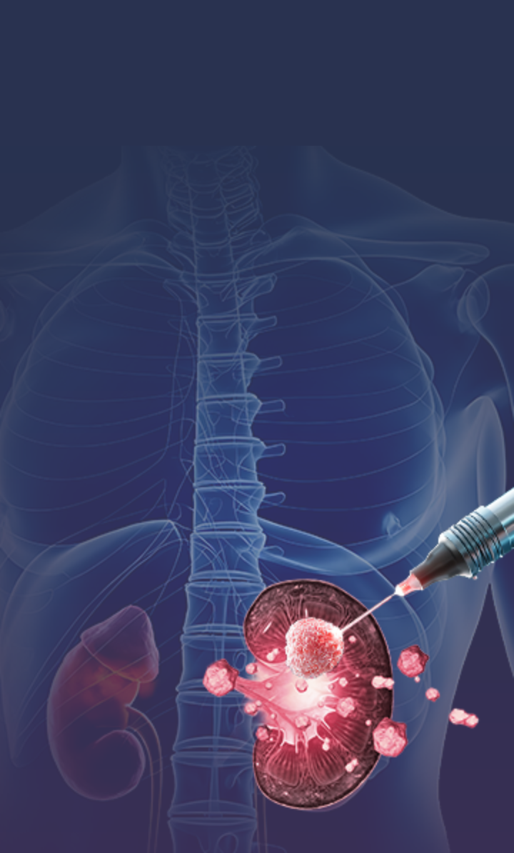 Kidney stone treatment care