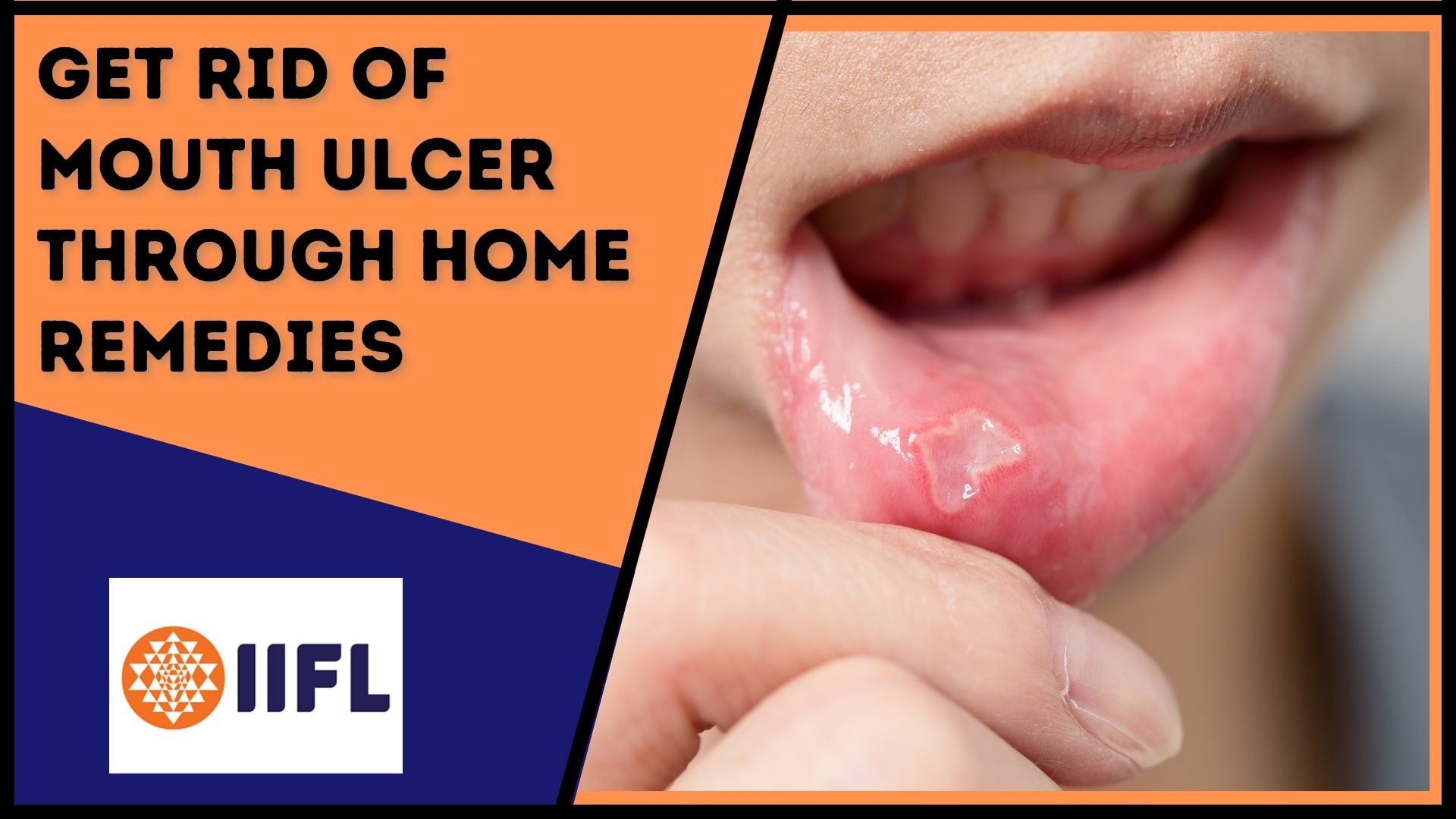 how-to-naturally-get-rid-of-canker-sores-or-mouth-ulcer-in-minutes