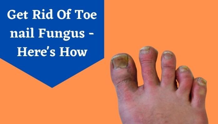 Toe nail Fungus