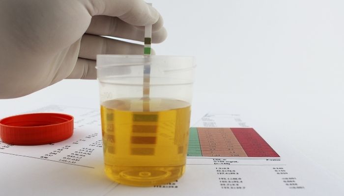 porphyria urine color