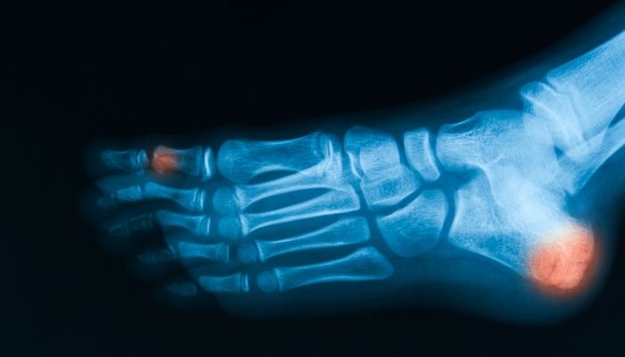 Oblique Fracture