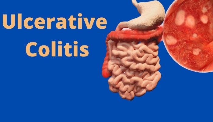 ulcerative colitis symptoms